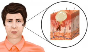 side effect of steroids acne