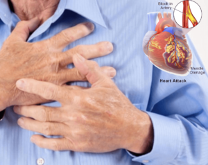 side effect of steroids Risk of heart attack 